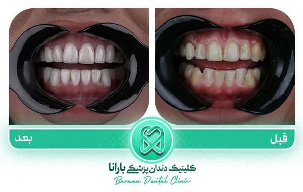 اقدامات قبل از کامپوزیت دندان