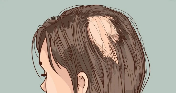 راه‌های مقابله با ریزش موی سکه ای از پیشگیری تا درمان