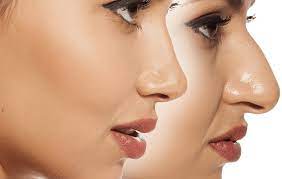 راز زیبایی سلبریتی ها: لیفت بینی بدون تیغ و بخیه