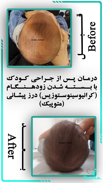 مدت زمان شکل گیری فرم سر نوزاد