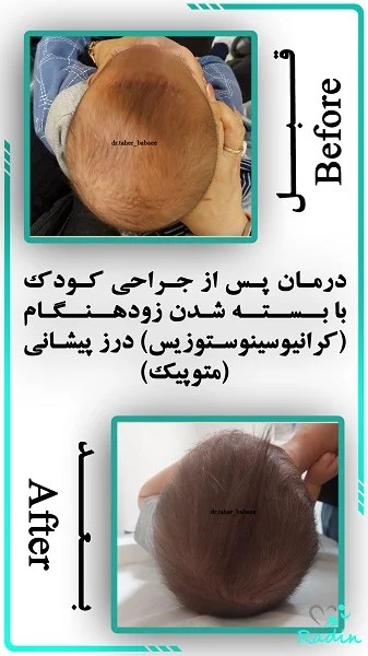 مدت زمان شکل گیری فرم سر نوزاد